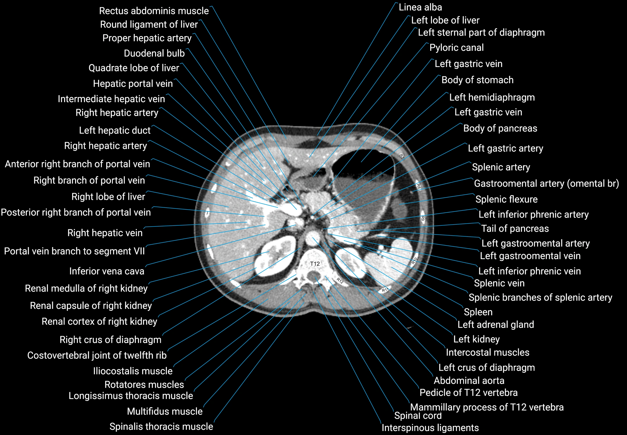 CT male pelvis axial cross sectional anatomy labelled radiology image -00042.webp